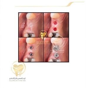 Portfolio of dental implants dr aziz goshaderoo 1 293x300 3