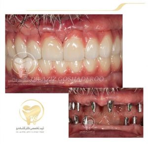 Portfolio of dental implants dr aziz goshaderoo 16 300x293 1