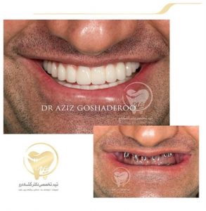 Portfolio of dental implants dr aziz goshaderoo 54 293x300 1