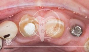 مراحل کاشت ایمپلنت دندان به روش پانچ دکتر عزیز گشاده رو