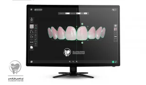 طراحی لبخند کامپیوتری در دندانپزشکی چیست؟