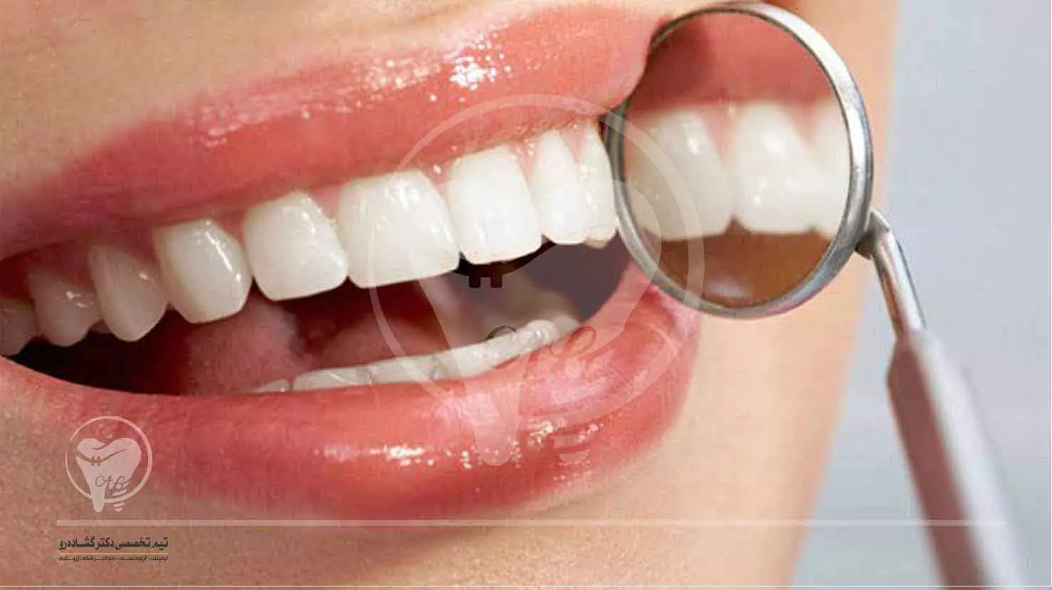 لمینت سرامیکی و انواع مختلف آن | تفاوت لمینت های سرامیکی