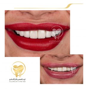 نمونه درمان های زیبایی دندان دکتر عزیز گشاده رو