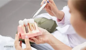 ایمپلنت دندان چقدر طول میکشد؟ | مراحل ایمپلنت دندان