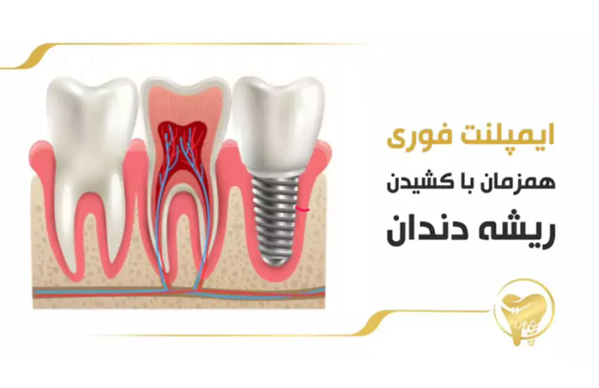 ایمپلنت فوری همزمان با کشیدن ریشه دندان