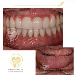 Portfolio of dental implants dr aziz goshaderoo 2
