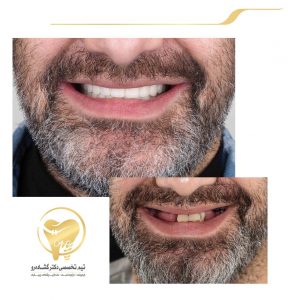 بازسازی کل دندانها با ایمپلنت و روکش و لمینیتهای سرامیکی