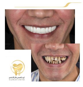 بازسازی کل دندانها با ایمپلنت و روکش و لمینیتهای سرامیکی