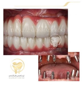 Portfolio of dental implants dr aziz goshaderoo 43 288x300 1