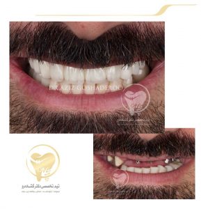 Portfolio of dental implants dr aziz goshaderoo 51 289x300 1