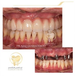 Portfolio of dental implants dr aziz goshaderoo 55 293x300 1