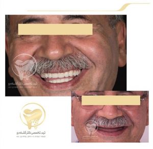 Portfolio of dental implants dr aziz goshaderoo 6