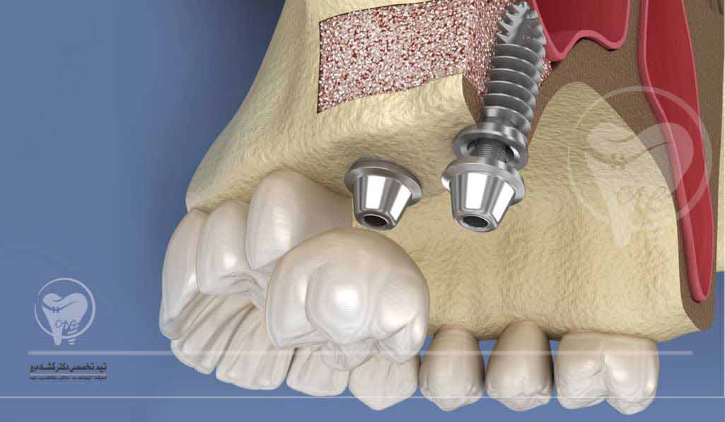 جراحی لیفت سینوس – ایمپلنت دندان