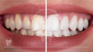 چسب سفید کننده دندان