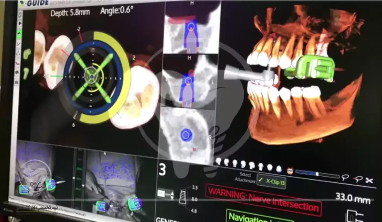 جدیدترین تکنولوژی ها در ایمپلنت دندان: جراحی با هدایت تصویربرداری 