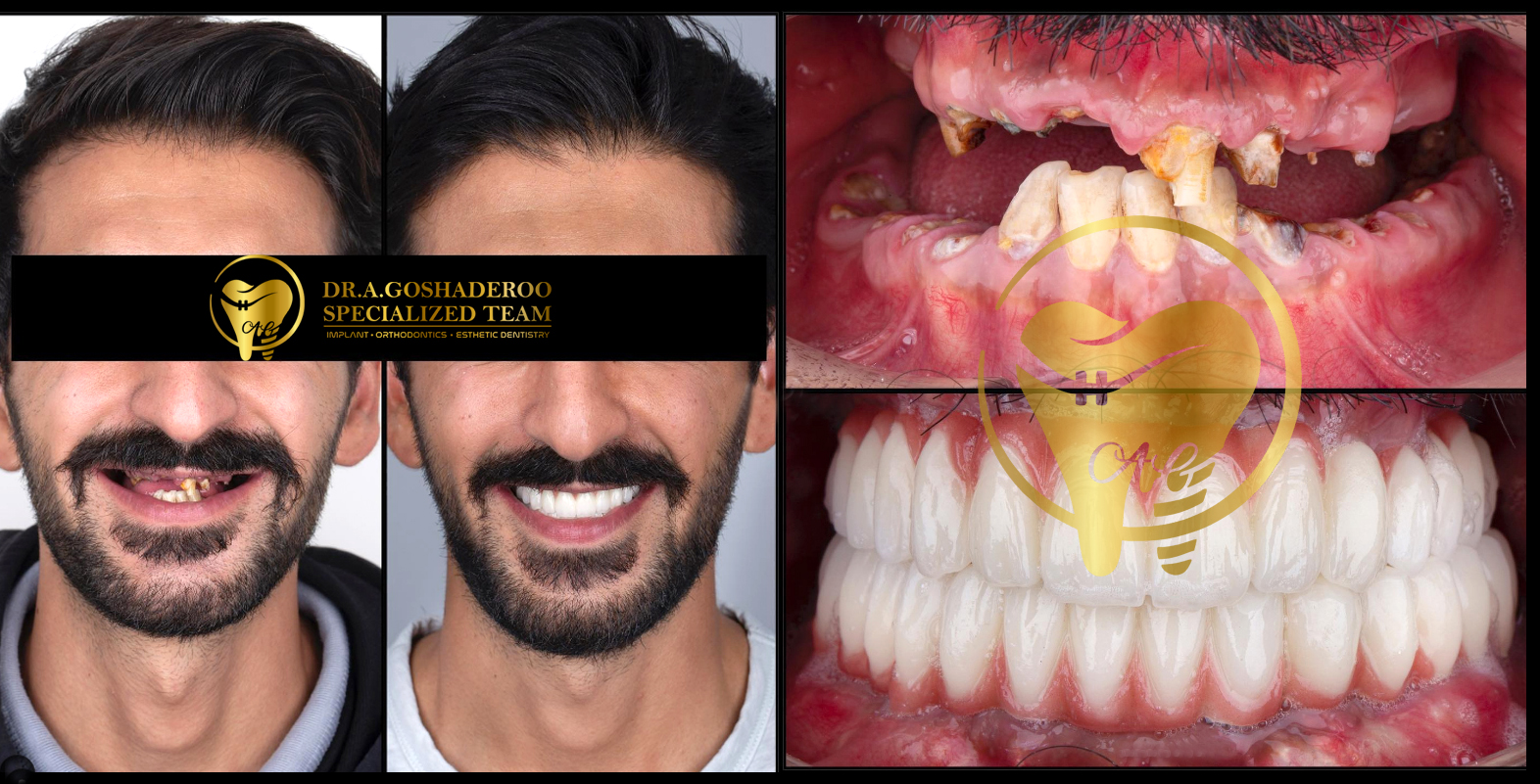 بازسازی کل دهان با ایمپلنت معجزه ایمپلنت دکتر عزیز گشاده رو متخصص پروتزهای دندانی ایمپلنت و زیبایی 2