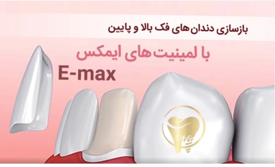 بازسازی دندان های فک بالا و پایین با لمینیت های ایمکس (E-max)