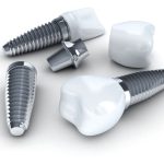 معجزه ایمپلنت در بازسازی دندان ها| فیلم