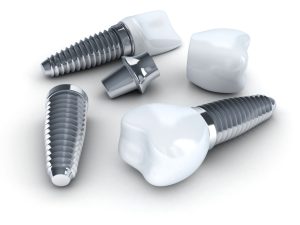معجزه ایمپلنت در بازسازی دندان ها| فیلم