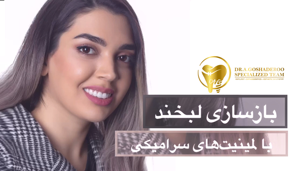 بازسازی لبخند با لمینیت های سرامیکی