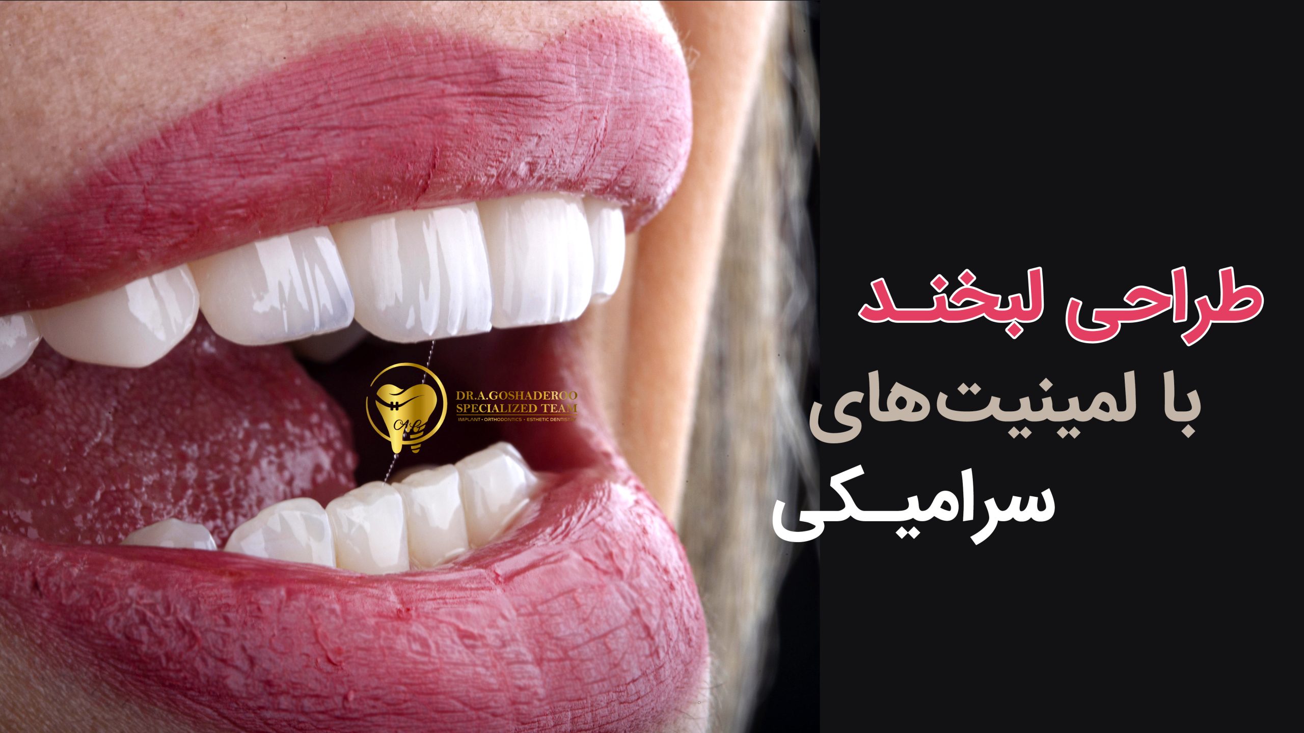 طراحی لبخند با لمینیت های سرامیکی _ فیلم
