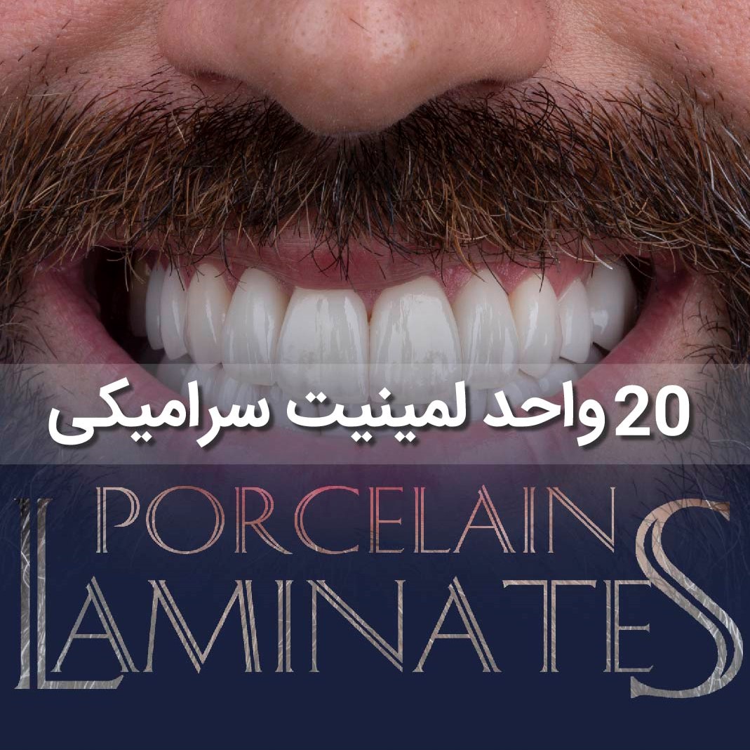 اصلاح طرح لبخند زیبا با لمینیت سرامیکی