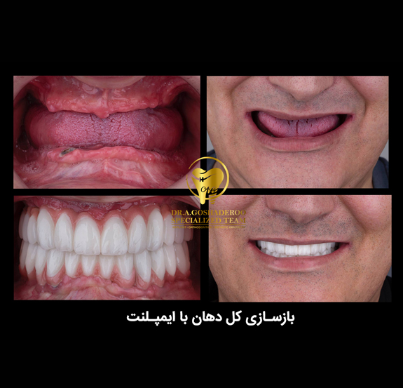 بازسازی کل دهان با ایمپلنت معجزه ایمپلنت دکتر عزیز گشاده رو متخصص پروتزهای دندانی ایمپلنت و زیبایی.
