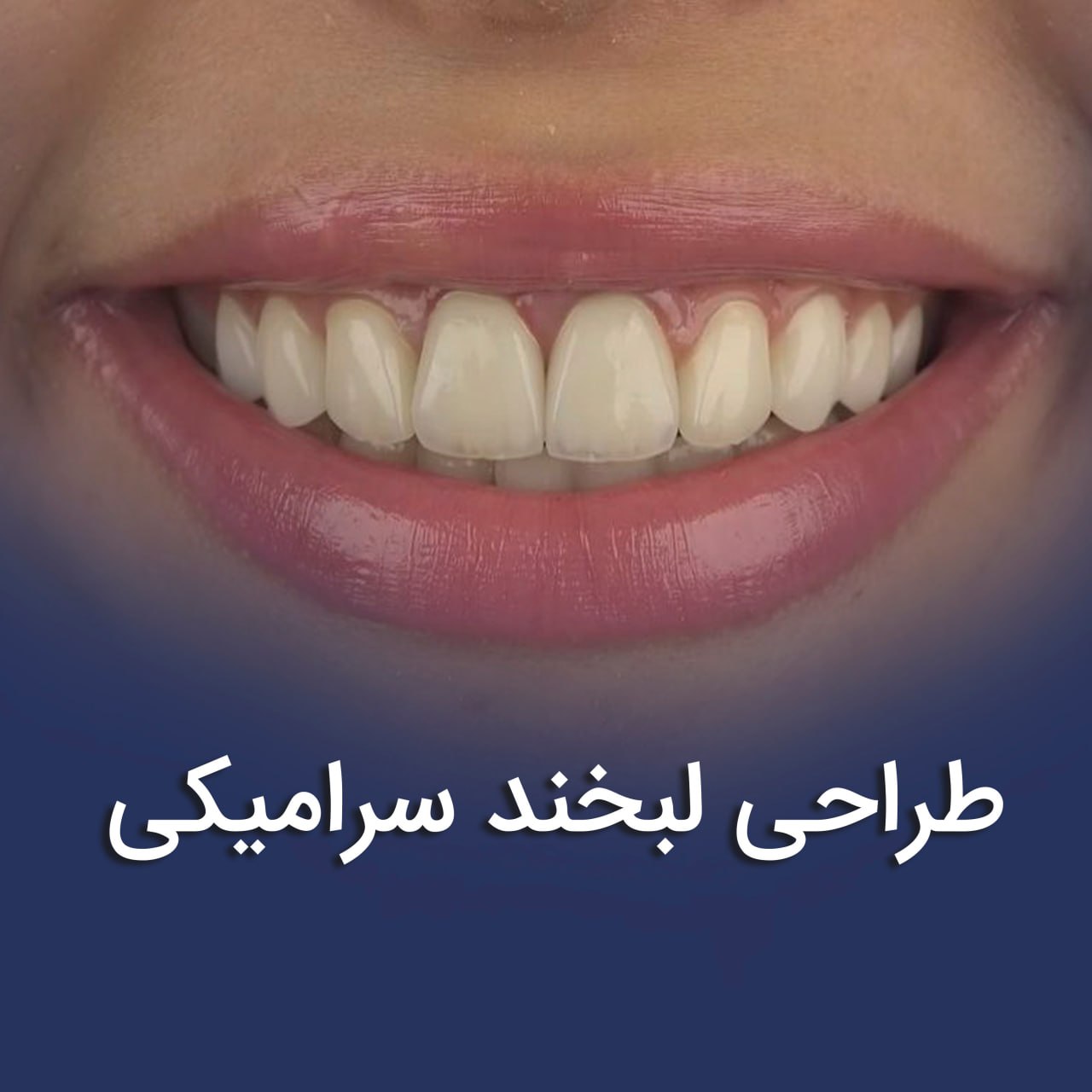 طراحی لبخند با روکش سرامیکی _ دکتر عزیز گشاده رو