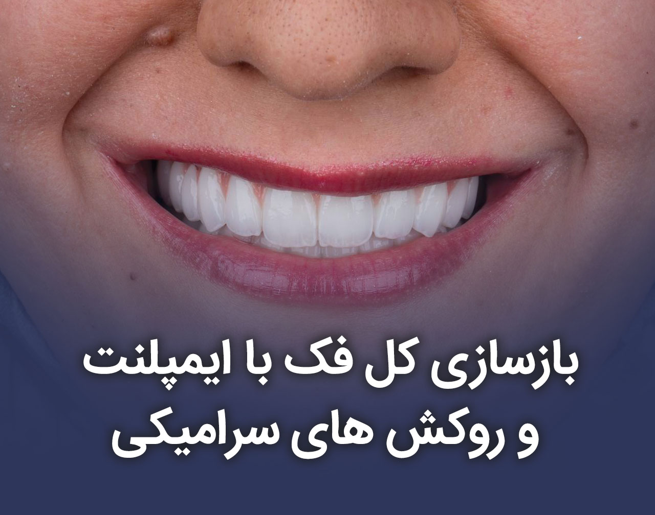 بازسازی کل فک با ایمپلنت و روکش های سرامیکی _ فیلم