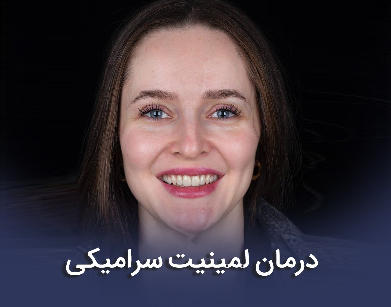 درمان لمینیت سرامیکی _ دکتر عزیز گشاده رو