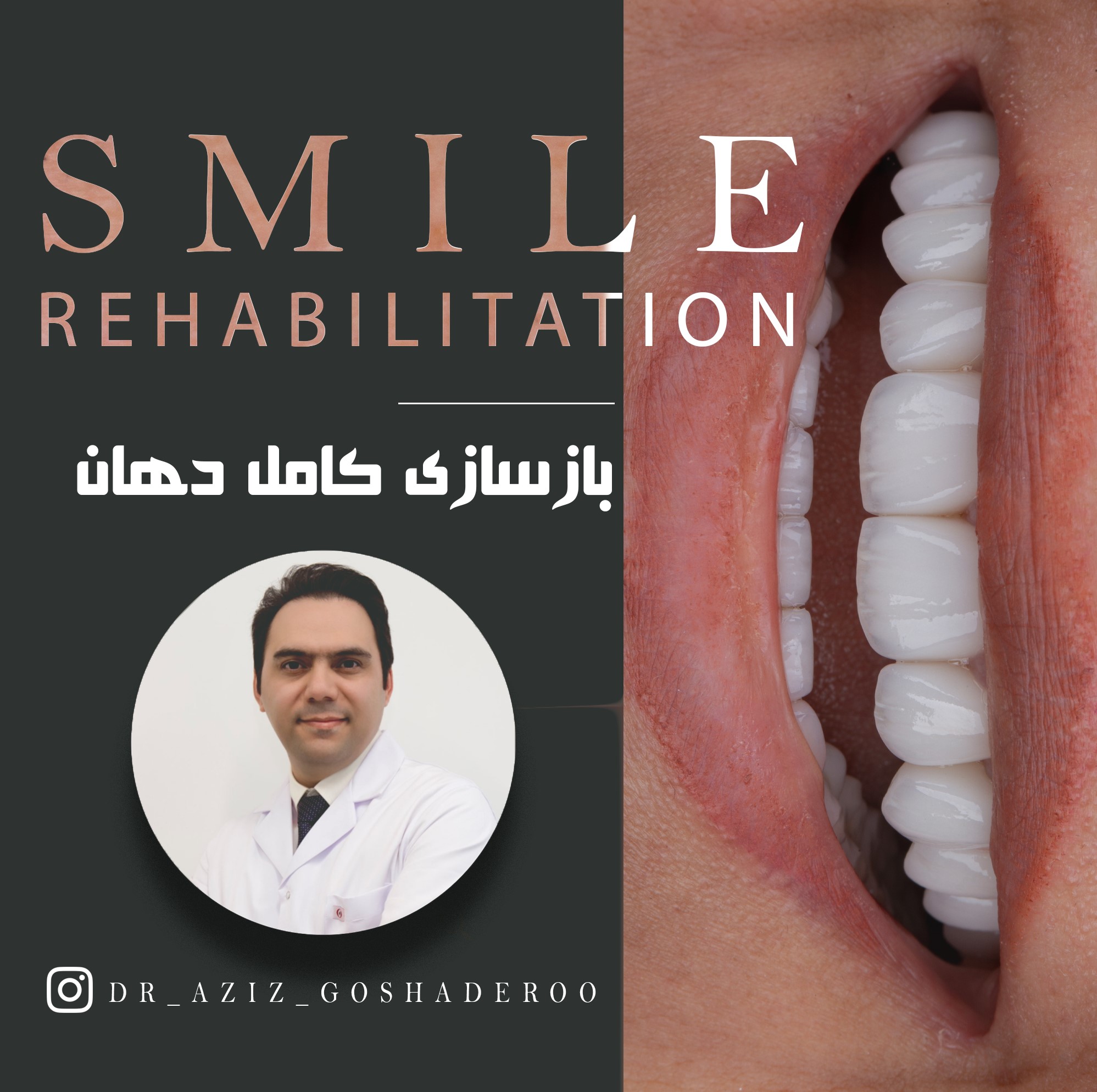 بازسازی کامل دهان با ایمپلنت و لامینت های سرامیکی چگونه است؟