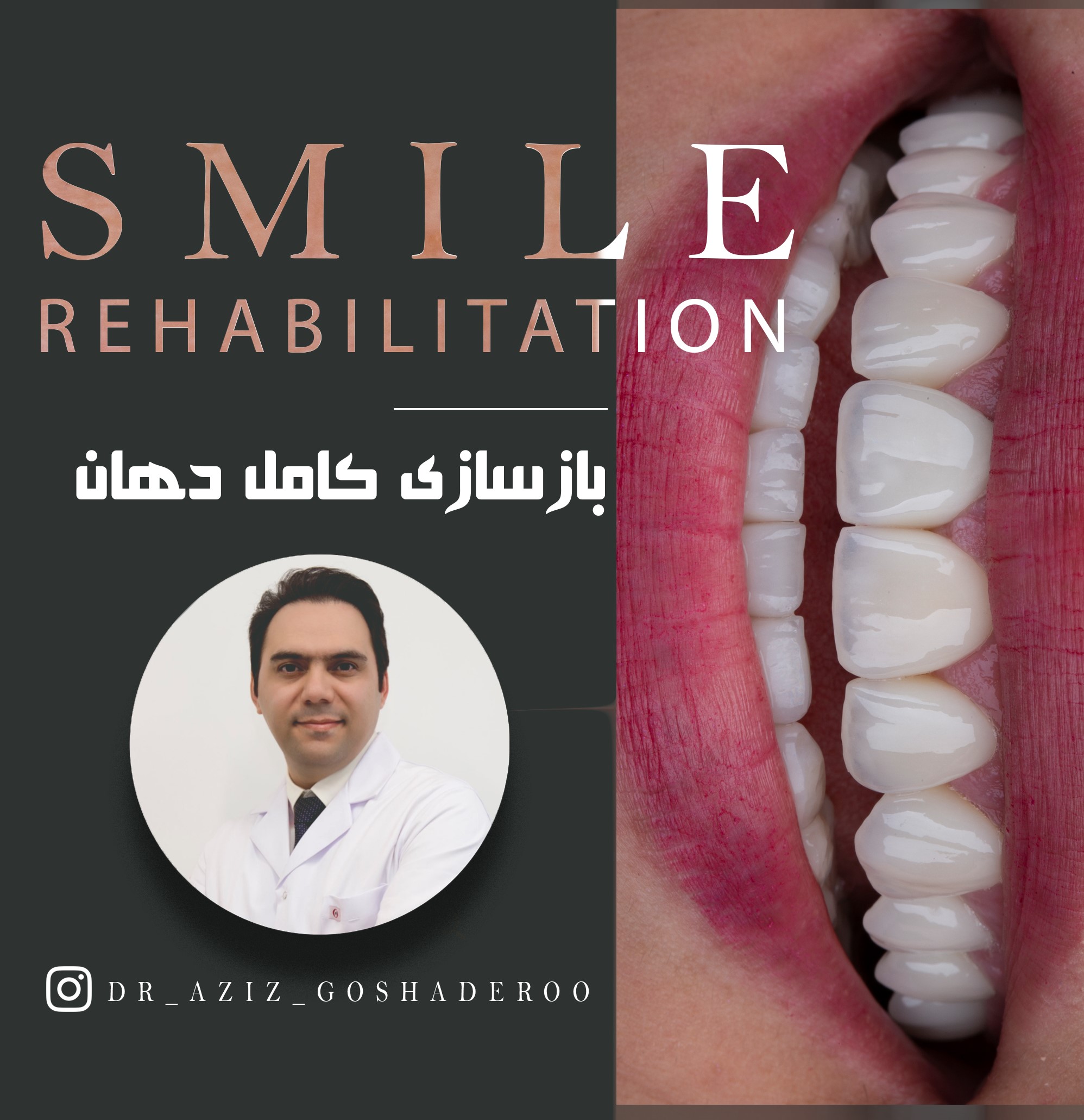 بازسازی لبخند و کل دهان _ دکتر عزیز گشاده رو
