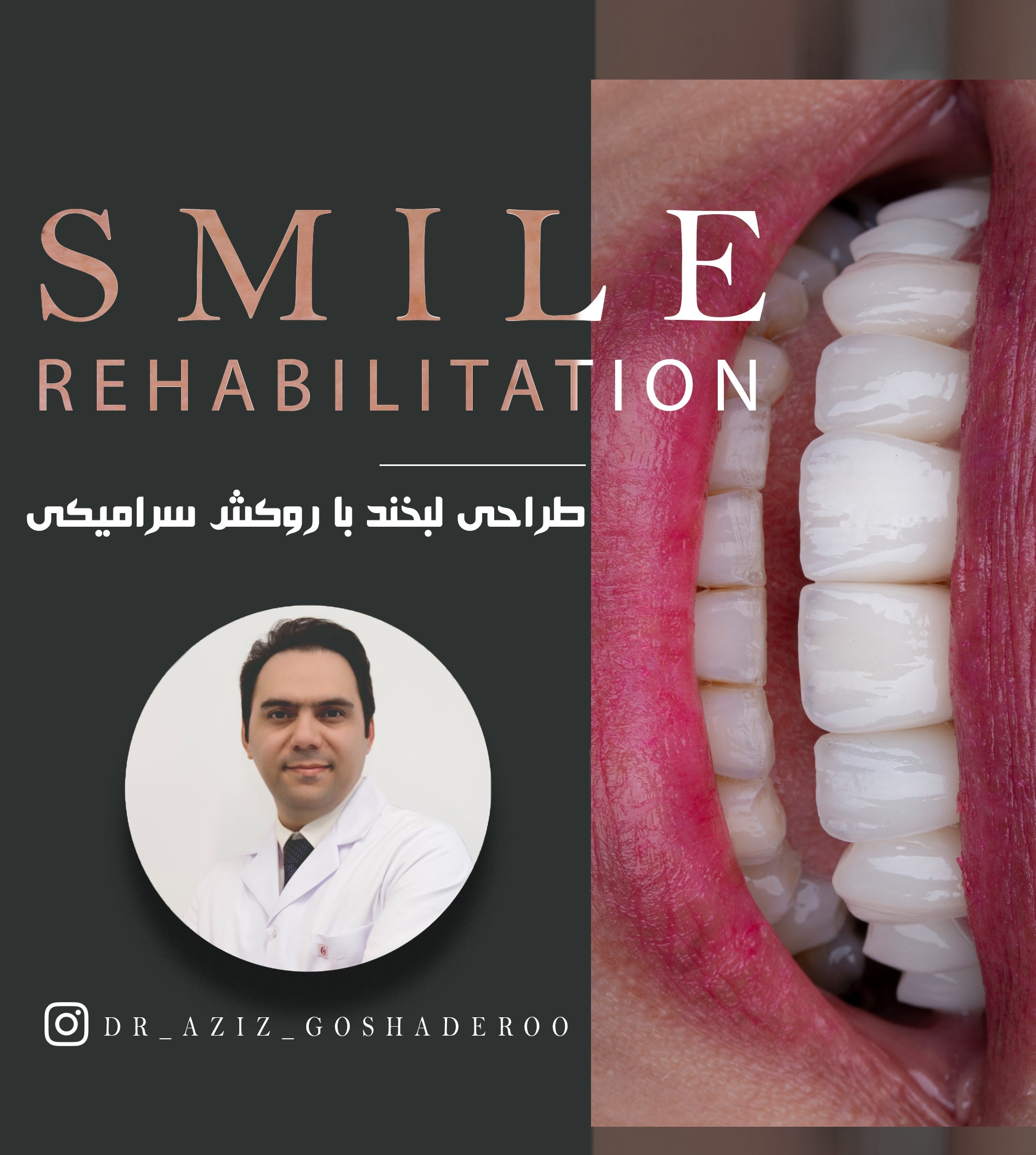 طراحی لبخند با روکش های سرامیکی