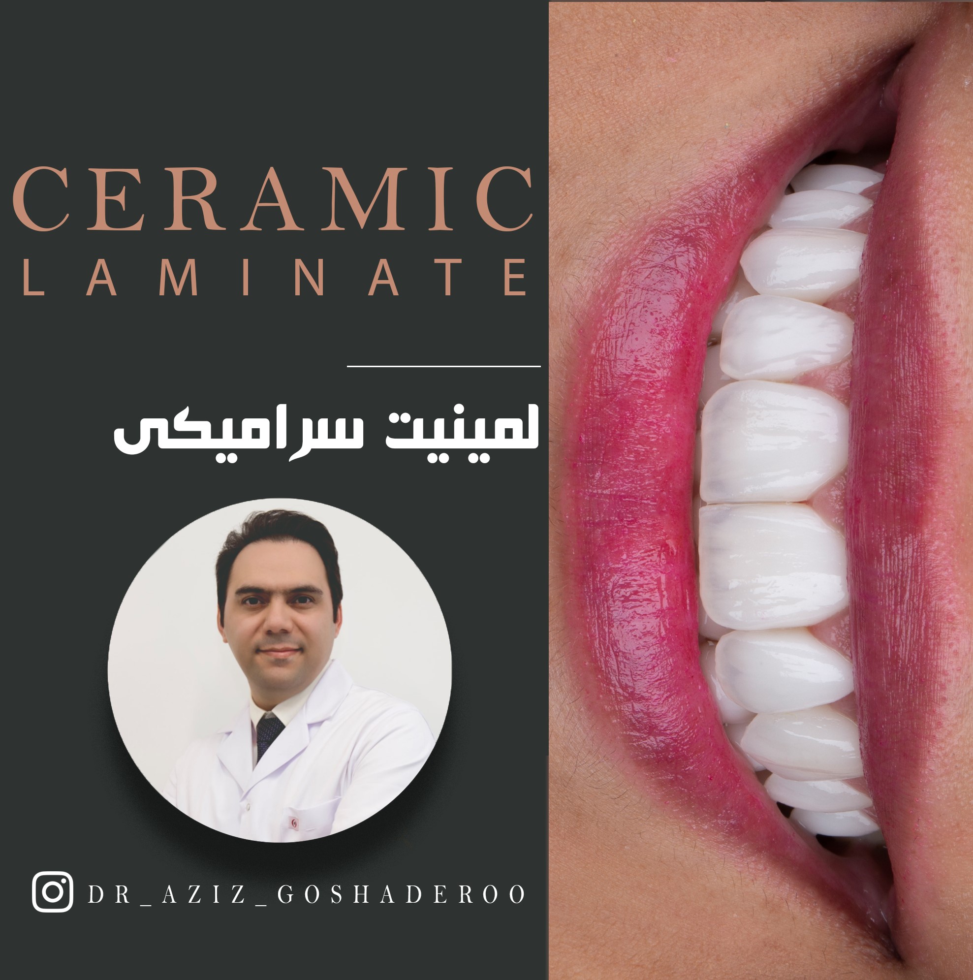 ویدئو لمینیت سرامیکی و لیفت لثه دندان