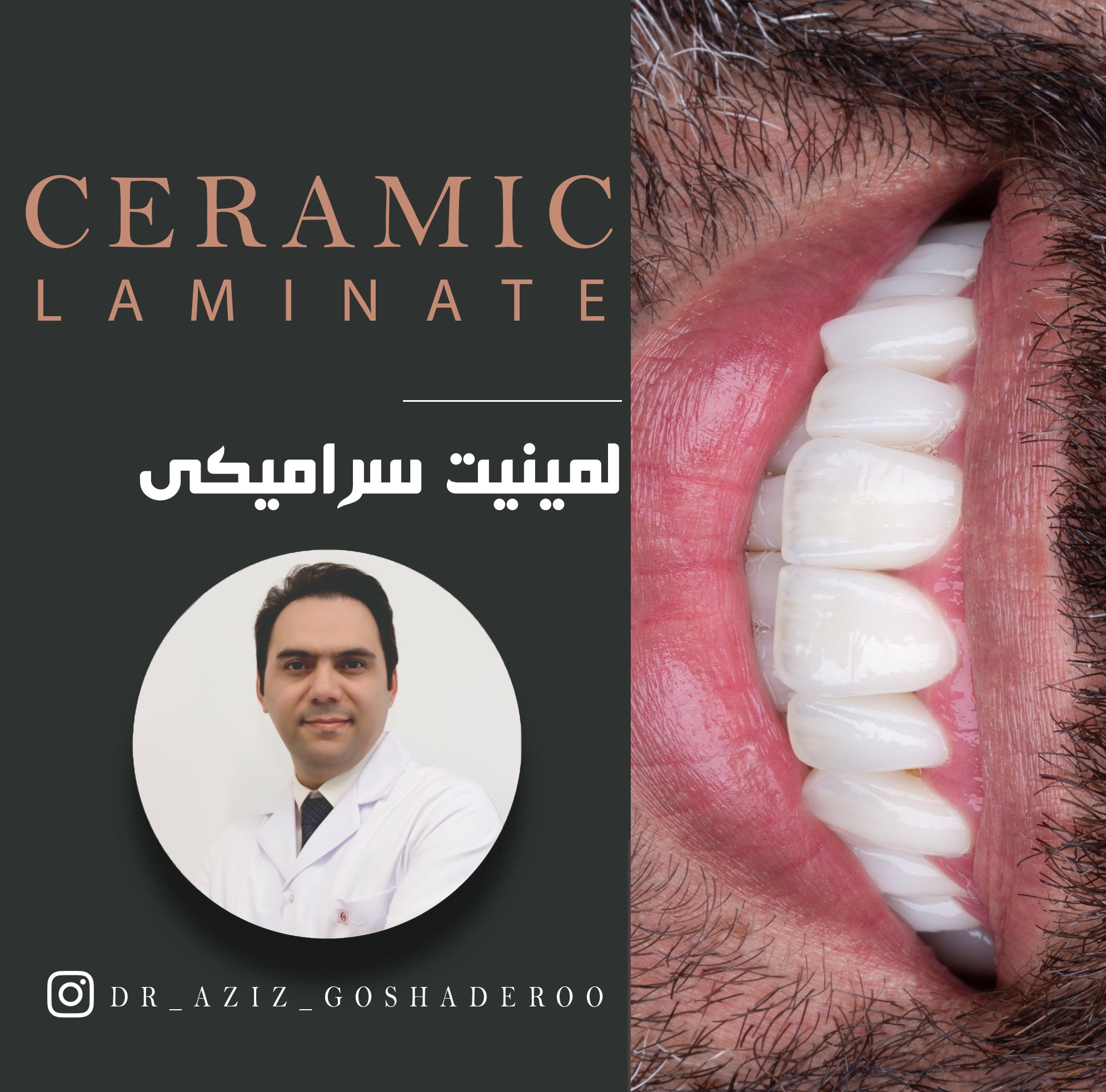 لمینیت سرامیکی دندان
