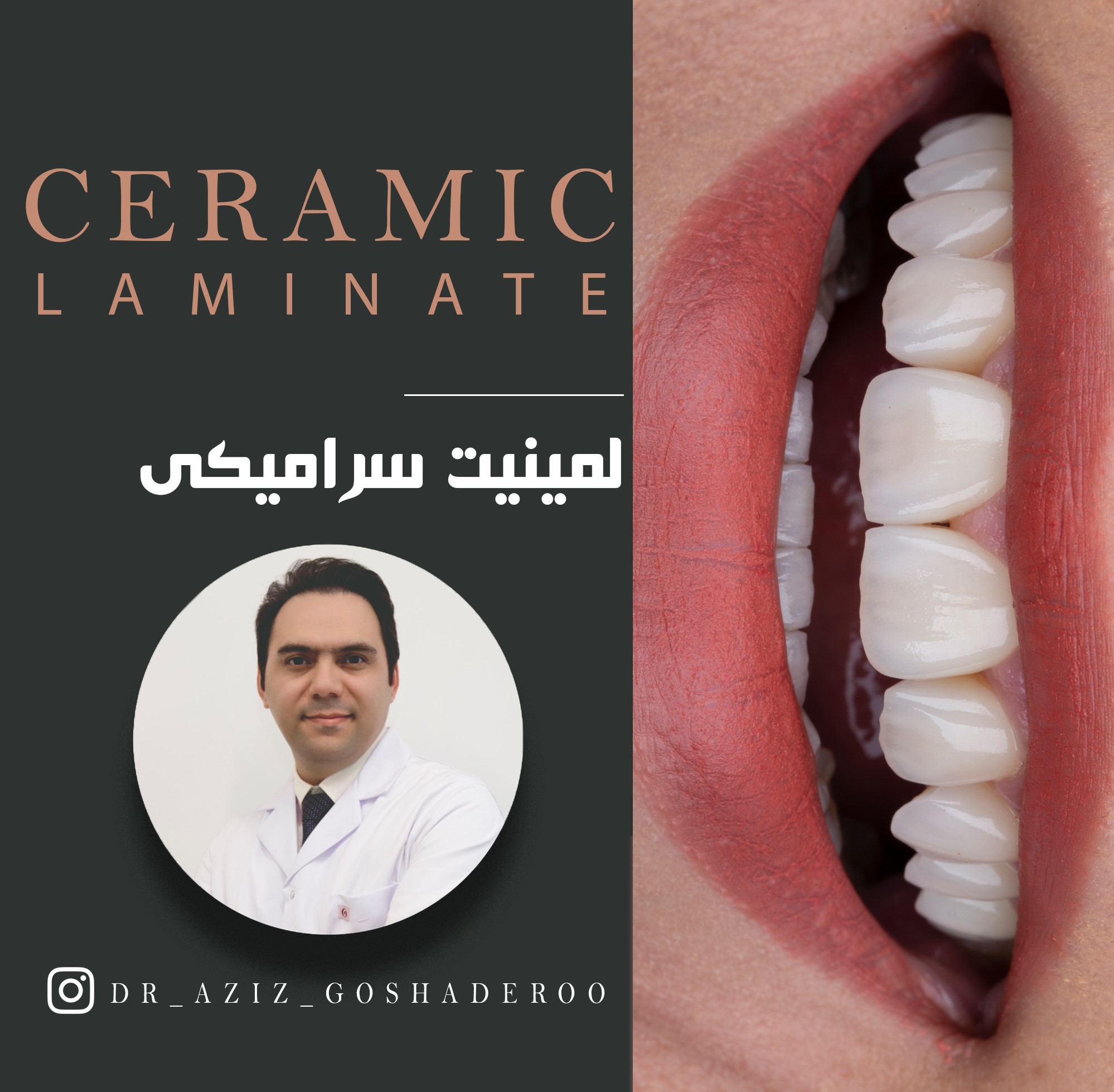طراحی لبخند زیبا با لمینیت سرامیکی