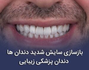 بازسازی کل دهان با لمینیت