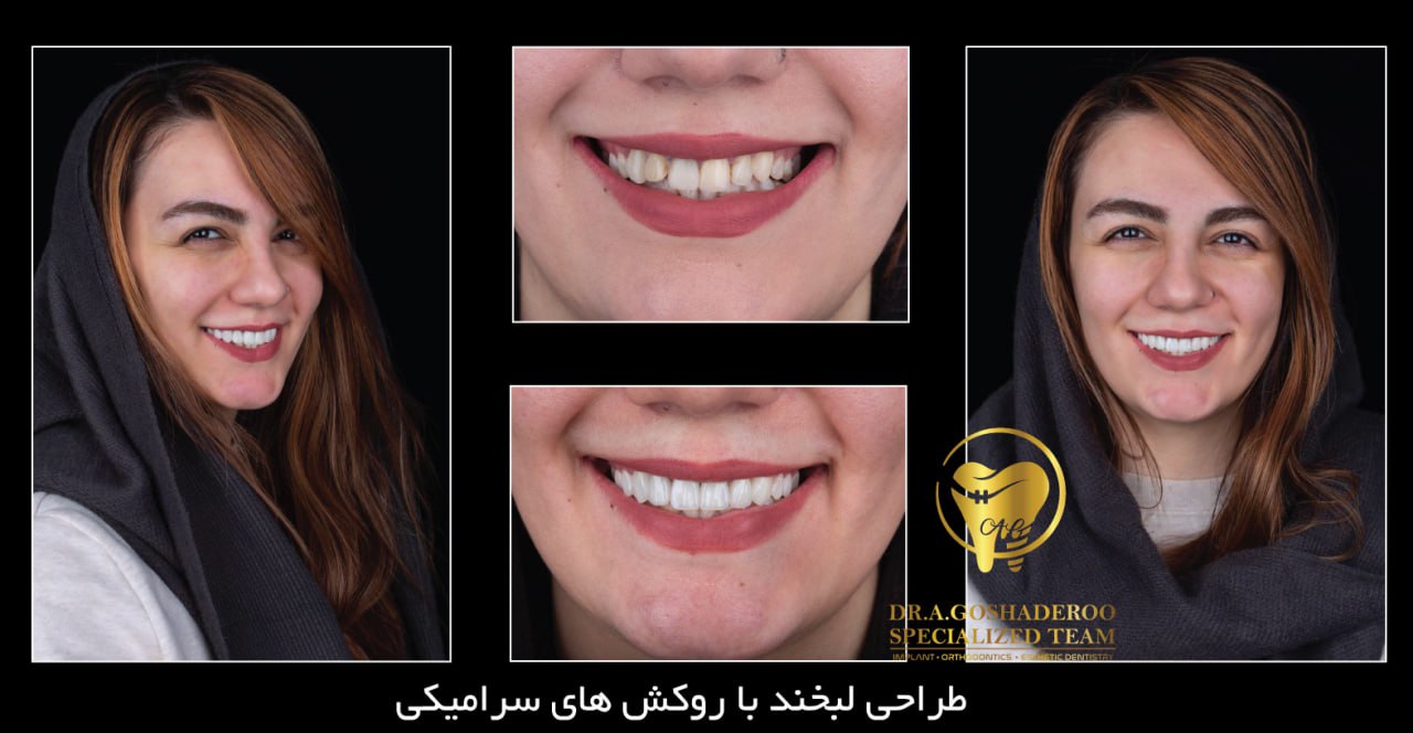 طراحی لبخند با روکش های سرامیکی