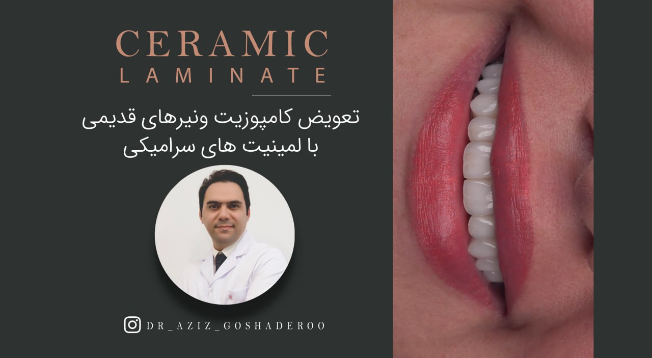 تعویض کامپوزیت ونیرهای قدیمی با لمینیت های سرامیکی