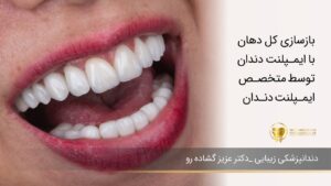 بازسازی کل دهان با ایمپلنت دندان