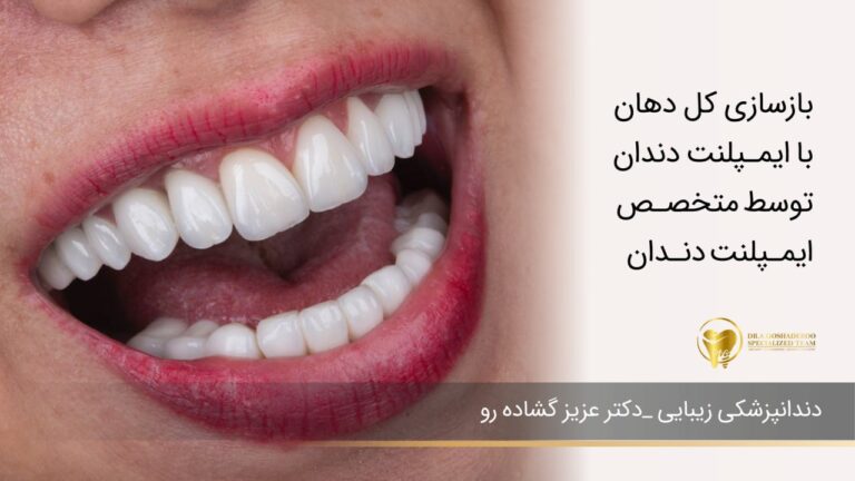 بازسازی کل دهان با ایمپلنت دندان