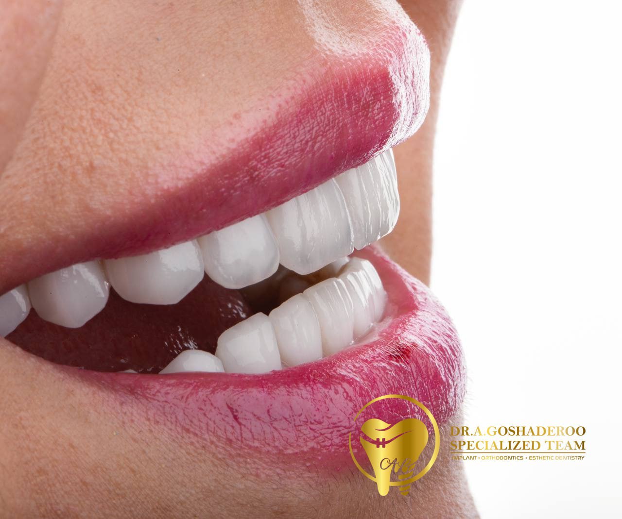 بازسازی کل دهان با لمینیت سرامیکی