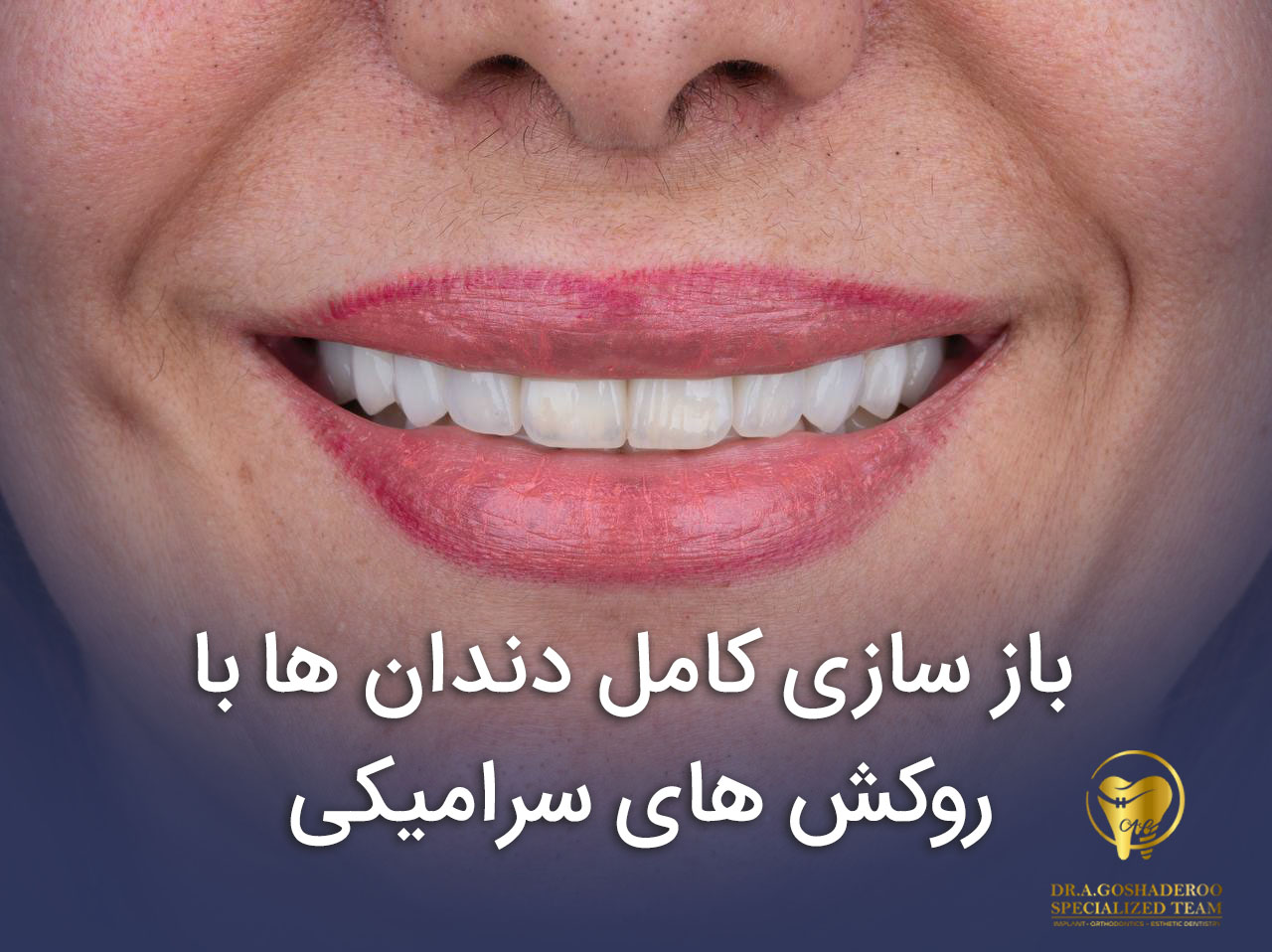 بازسازی کامل دندان ها با روکش های سرامیکی
