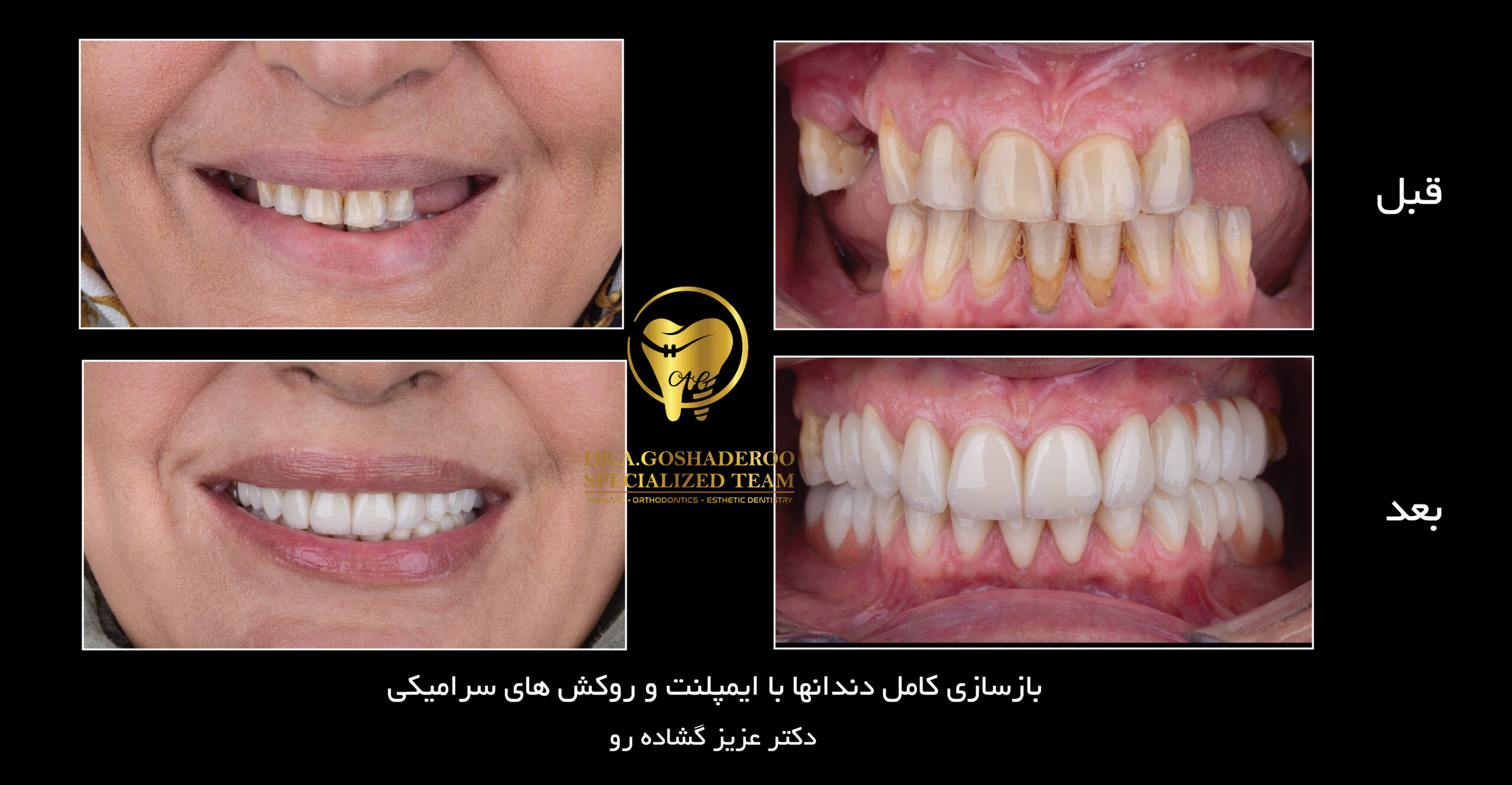 بازسازی کامل دندانها با ایمپلنت و روکش های سرامیکی-0۱