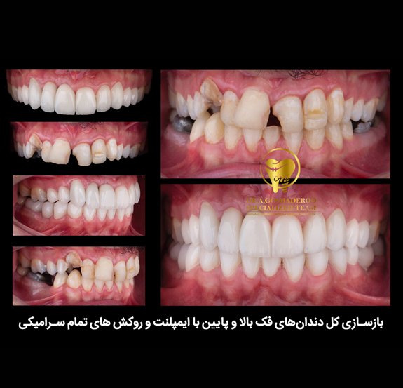 بازسازی کل دندانهای فک بالا و پایین با ایمپلنت و روکش های تمام سرامیکی دکتر عزیز گشاده رو معجزه ایمپلنت 3.