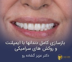بازسازی کامل دندانها با ایمپلنت و روکش های سرامیکی