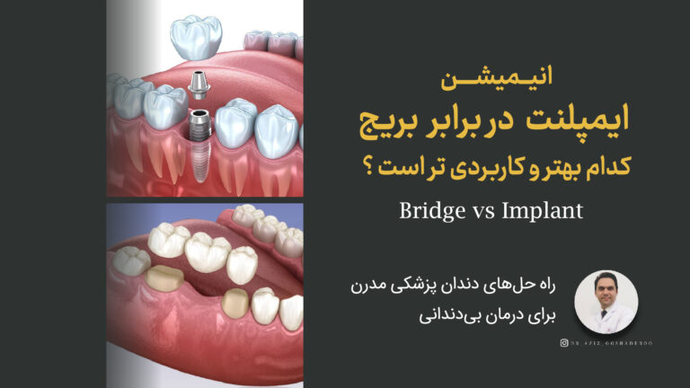 بریج در برابر ایمپلنت