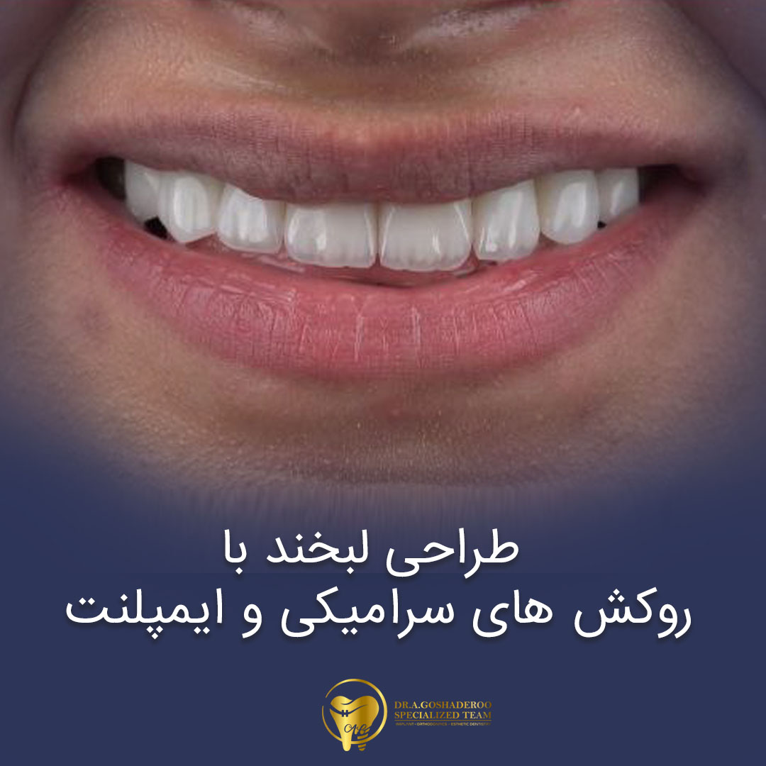 طراحی لبخند با روکشهای سرامیکی و ایمپلنت
