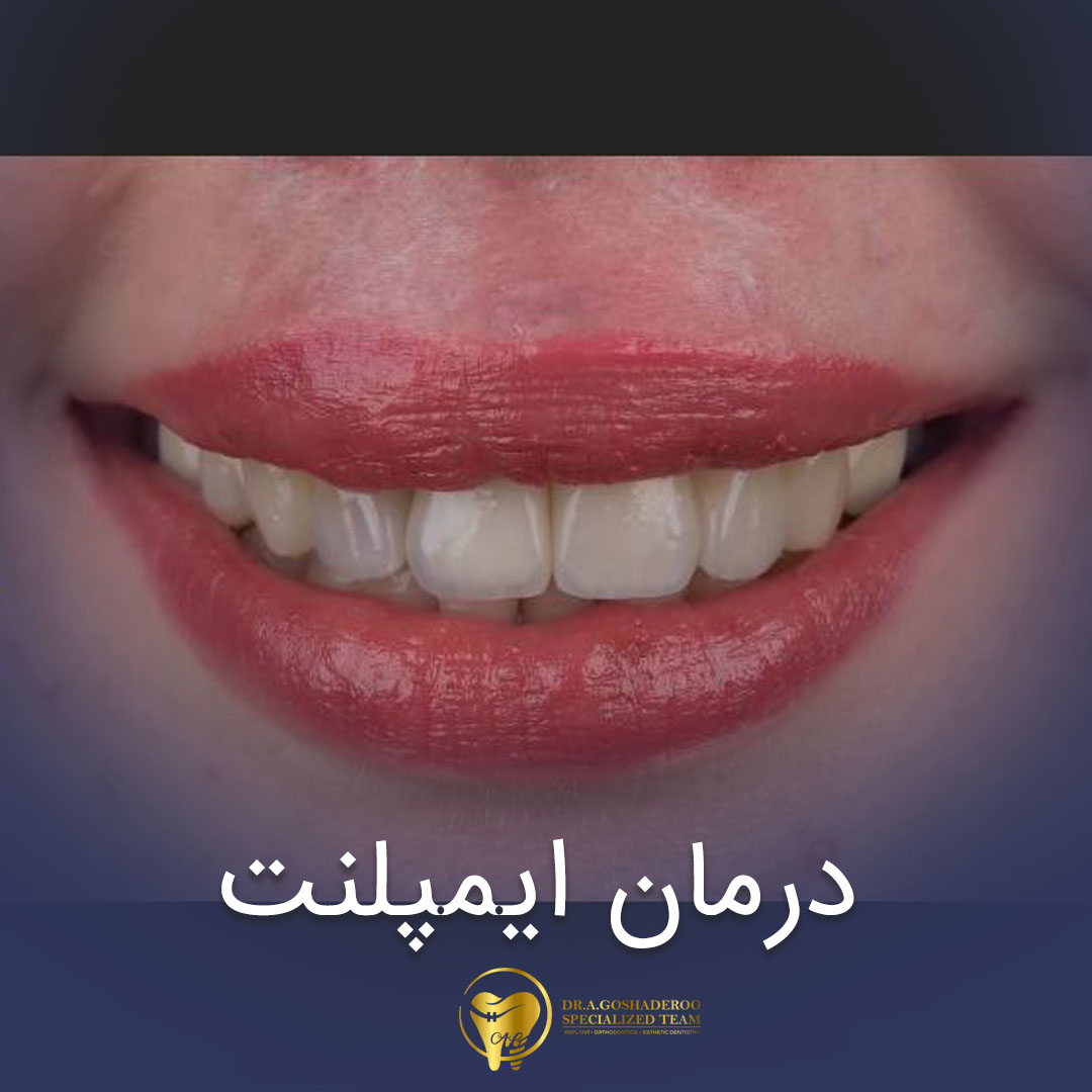 هنر ایمپلنت دندان سانترال