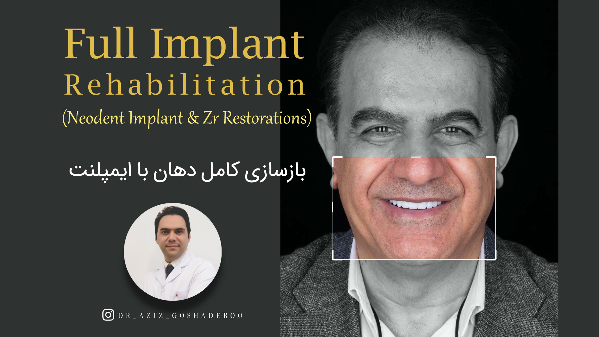 بازسازی کامل دهان با ایمپلنت